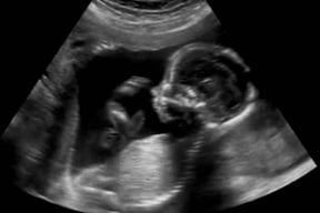 20 weeks ultrasound twins